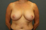 BREAST REDUCTION: Case 30 Before